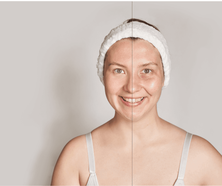 Understanding Glutathione Shots for Skin Whitening: Safety, Causes, and Effects